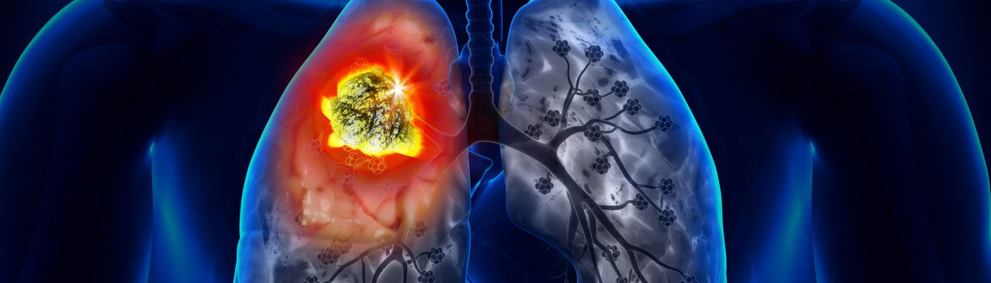 el cáncer de pulmón - Traducere în română - exemple în spaniolă | Reverso Context