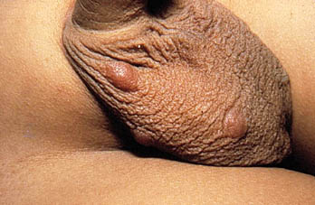 Avances en el tratamiento de escabiosis