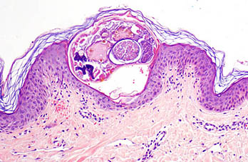 Avances en el tratamiento de la escarbosis